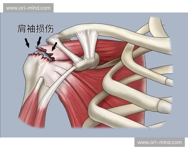 肩袖肌群功能与损伤机制研究进展及临床治疗策略分析